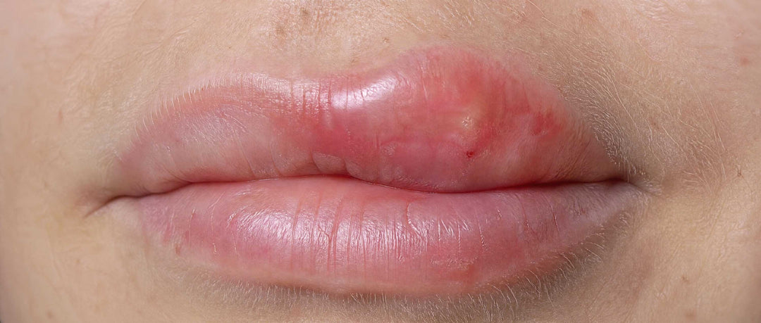 macro of stung lip